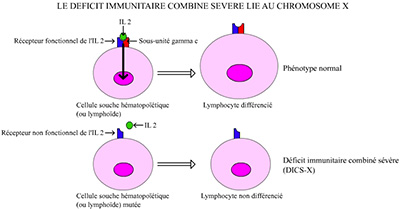 Origine du déficit immunitaire combiné sévère lié au chromosome X (DISC-X)