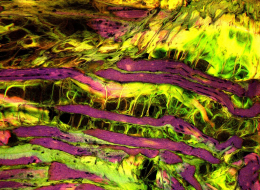 Dystrophie musculaire observée au microscope optique
