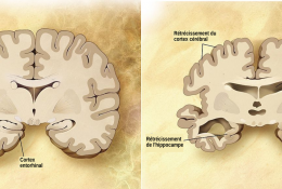 Comparaison d'un cerveau sain et d'un cerveau d'un patient atteint de la maladie d'Alzheimer
