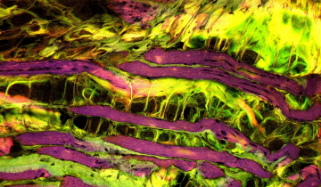 Dystrophie musculaire observée au microscope optique