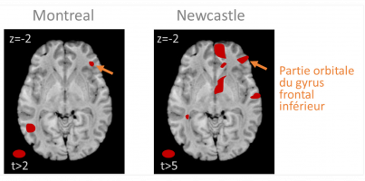 Figure 6 - Relation entre la concentration locale de matière blanche (WM) et le test de violation mélodique (une note hors de la gamme est insérée dans la mélodie) pour deux échantillons de patients à Montréal et Newcastle.