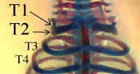 Exemple d’invalidations multiples : ensemble des paralogues HOX8 (HOXB8, C8 et D8)