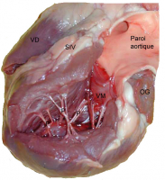 Ventricule gauche ouvert