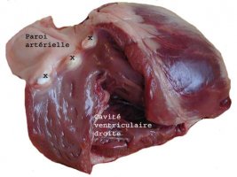 Valvule sigmoïde pulmonaire