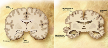 Comparaison d'un cerveau sain et d'un cerveau d'un patient atteint de la maladie d'Alzheimer