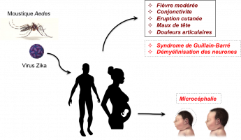 Les symptômes développés après une infection par le virus Zika suite à la piqûre d’un moustique infecté.