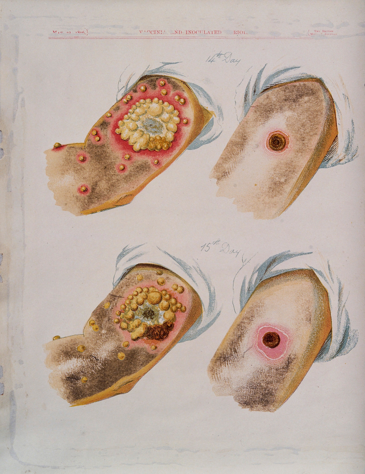 Comparaison des pustules dues à la variole (à gauche) et à la vaccine (à droite)