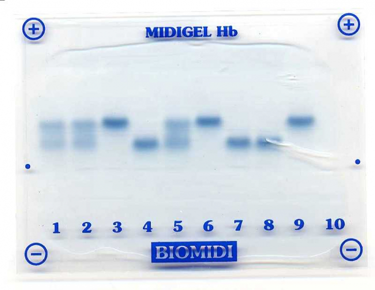 Electrophorèse des hémoglobines A et S sur gel d'agarose