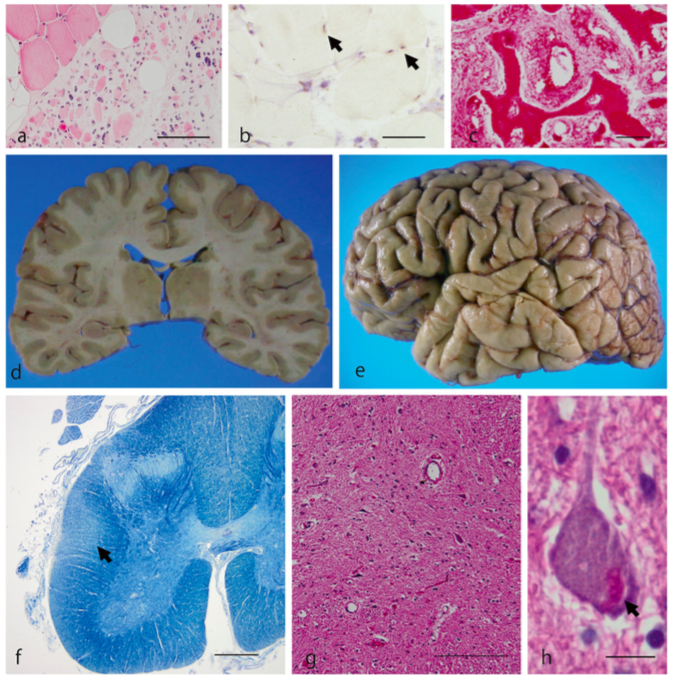 Neuropathologie d’un patient atteint de sclérose latérale amyotrophique et ayant une mutation dans le gène VCP