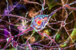 Inclusions neuronales dans la maladie de Huntington - Vue d'artiste