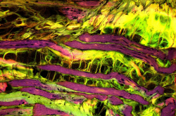Dystrophie musculaire observée au microscope optique