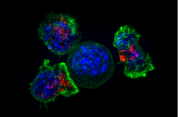 Cellule cancéreuse entourée par des lymphocytes T