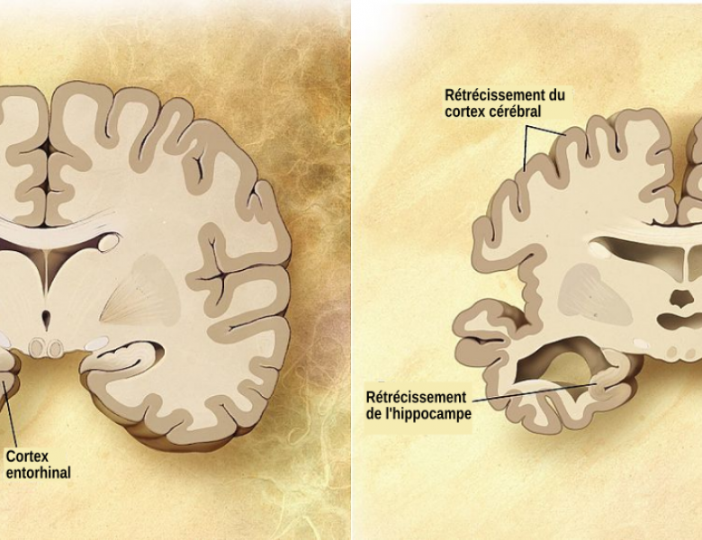 Comparaison d'un cerveau sain et d'un cerveau d'un patient atteint de la maladie d'Alzheimer